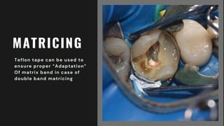 MATRICING
Teflon tape can be used to
ensure proper “Adaptation”
Of matrix band in case of
double band matricing
 
