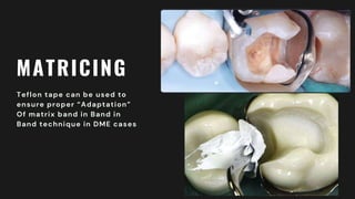 MATRICING
Teflon tape can be used to
ensure proper “Adaptation”
Of matrix band in Band in
Band technique in DME cases
 
