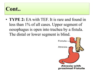 Cont..
• TYPE 2: EA with TEF. It is rare and found in
less than 1% of all cases. Upper segment of
oesophagus is open into trachea by a fistula.
The distal or lower segment is blind.
 