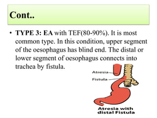 Cont..
• TYPE 3: EA with TEF(80-90%). It is most
common type. In this condition, upper segment
of the oesophagus has blind end. The distal or
lower segment of oesophagus connects into
trachea by fistula.
 