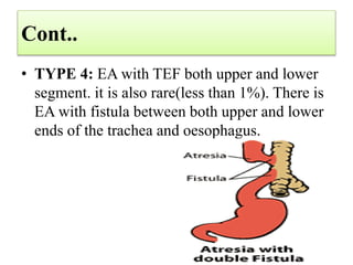 Cont..
• TYPE 4: EA with TEF both upper and lower
segment. it is also rare(less than 1%). There is
EA with fistula between both upper and lower
ends of the trachea and oesophagus.
 