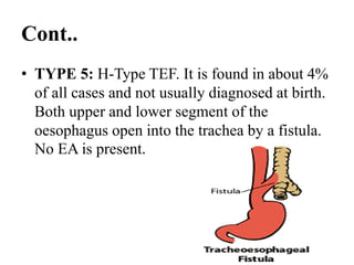 Cont..
• TYPE 5: H-Type TEF. It is found in about 4%
of all cases and not usually diagnosed at birth.
Both upper and lower segment of the
oesophagus open into the trachea by a fistula.
No EA is present.
 