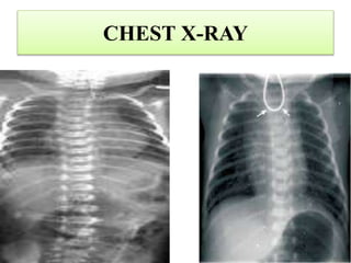 CHEST X-RAY
 