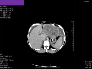 focal nodular hyprplasia FNH case PRESENTATION | PPTX