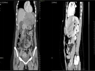 focal nodular hyprplasia FNH case PRESENTATION | PPTX