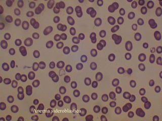 Anemia sideroblastica
 