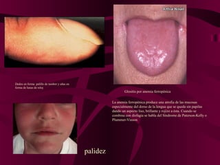 Glositis por anemia ferropénica
La anemia ferropénica produce una atrofia de las mucosas
especialmente del dorso de la lengua que se queda sin papilas
dando un aspecto liso, brillante y rojizo a ésta. Cuando se
combina con disfagia se habla del Síndrome de Paterson-Kelly o
Plummer-Vinson
Dedos en forma palillo de tambor y uñas en
forma de lunas de reloj
palidez
 