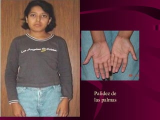 Palidez de
las palmas
 