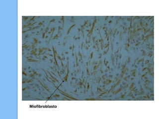 Fibroblasto - Variantes
 Célula reticular: Especializada en producción de fibras reticulares.
 Elastocito: Especializada...