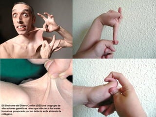 El Síndrome de Ehlers-Danlos (SED) es un grupo de
alteraciones genéticas raras que afectan a los seres
humanos provocado por un defecto en la síntesis de
colágeno.
 