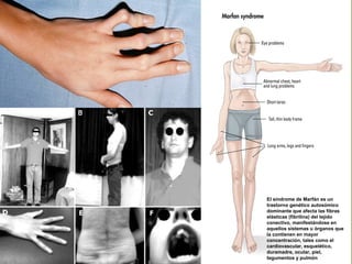 El síndrome de Marfán es un
trastorno genético autosómico
dominante que afecta las fibras
elásticas (fibrilina) del tejido
conectivo, manifestándose en
aquellos sistemas u órganos que
la contienen en mayor
concentración, tales como el
cardiovascular, esquelético,
duramadre, ocular, piel,
tegumentos y pulmón
 