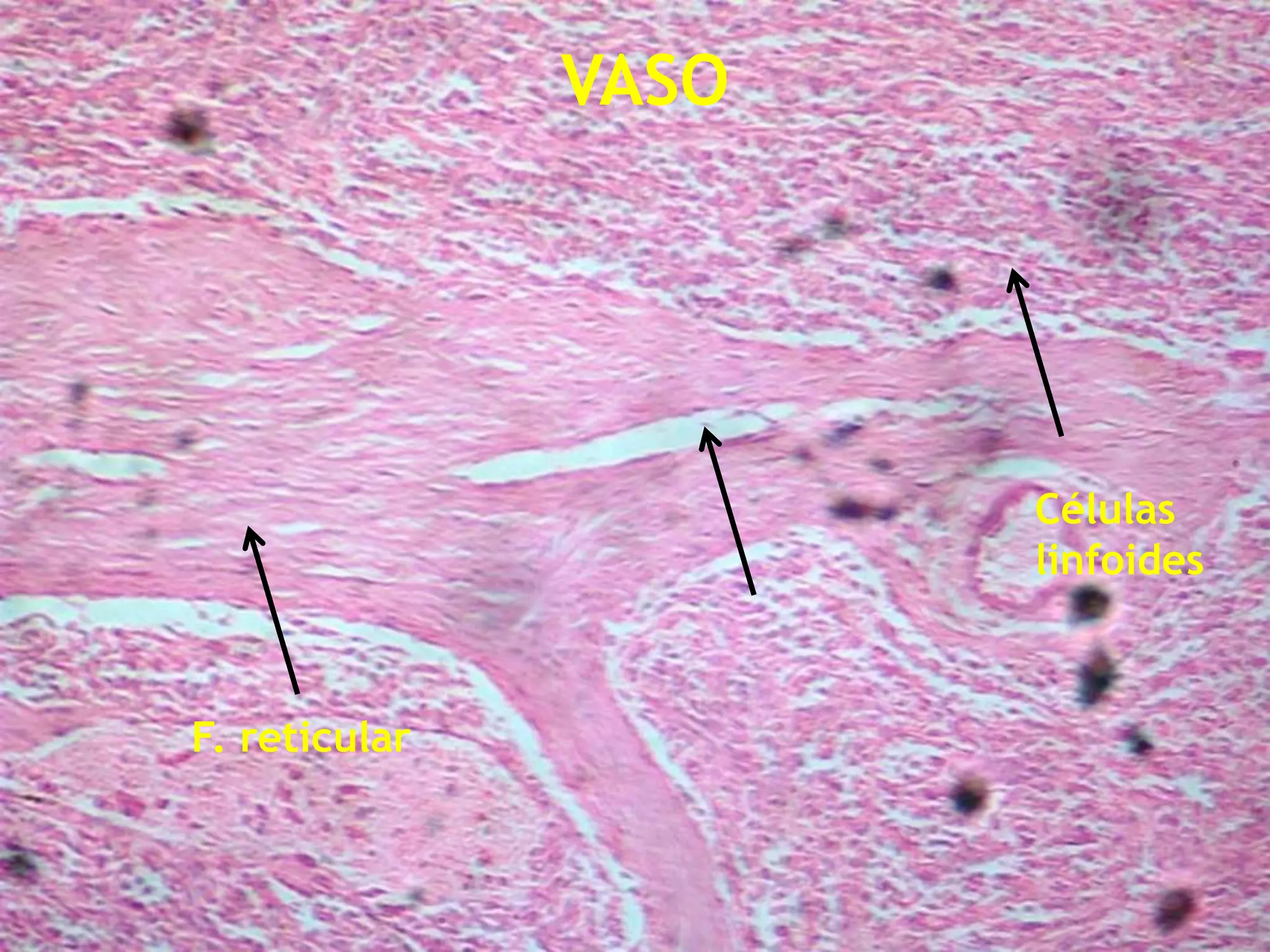 VASO Células linfoides F. reticular