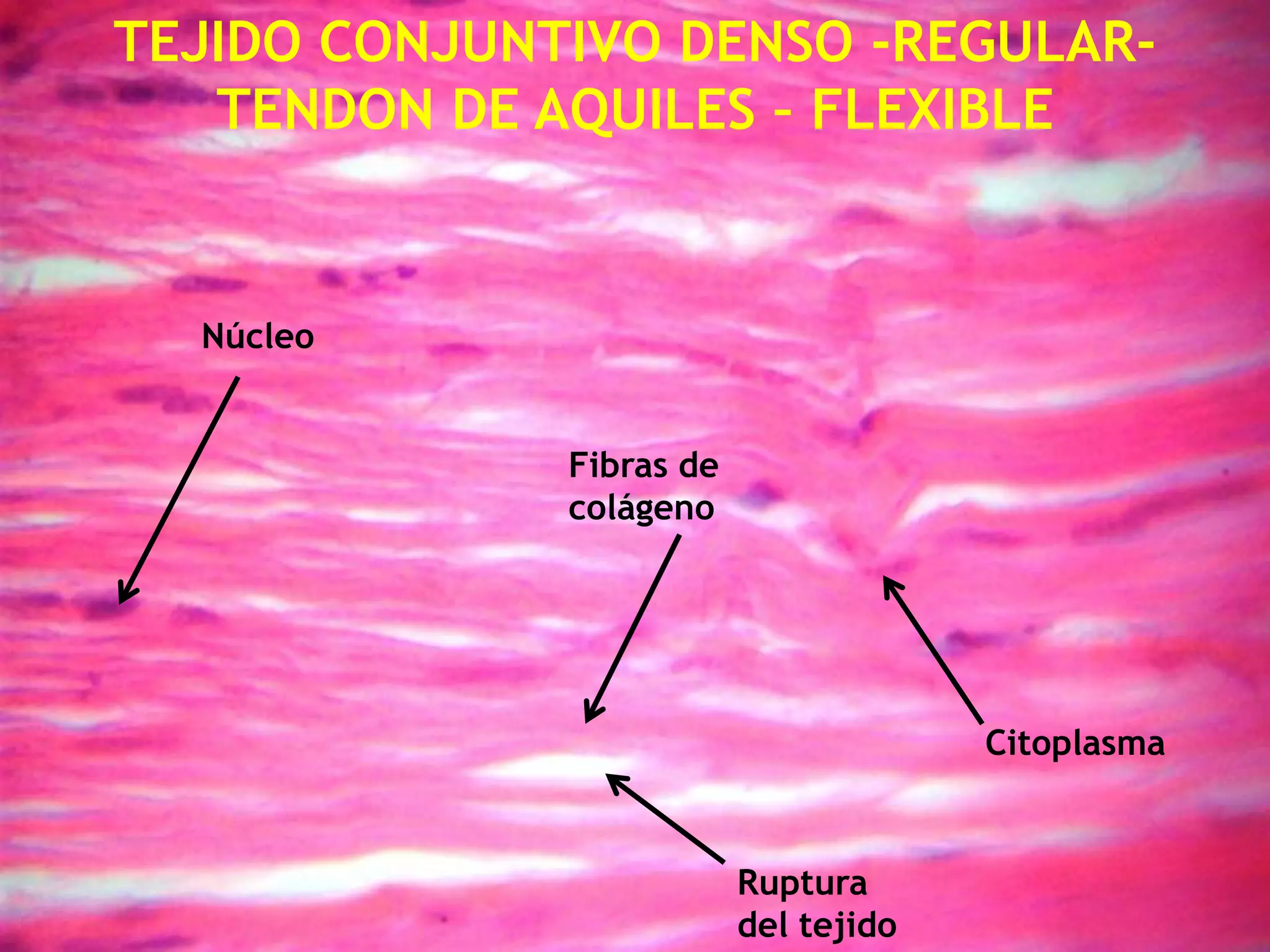 TEJIDO CONJUNTIVO DENSO -REGULAR-TENDON DE AQUILES – FLEXIBLENúcleoFibras de colágeno CitoplasmaRuptura del tejido