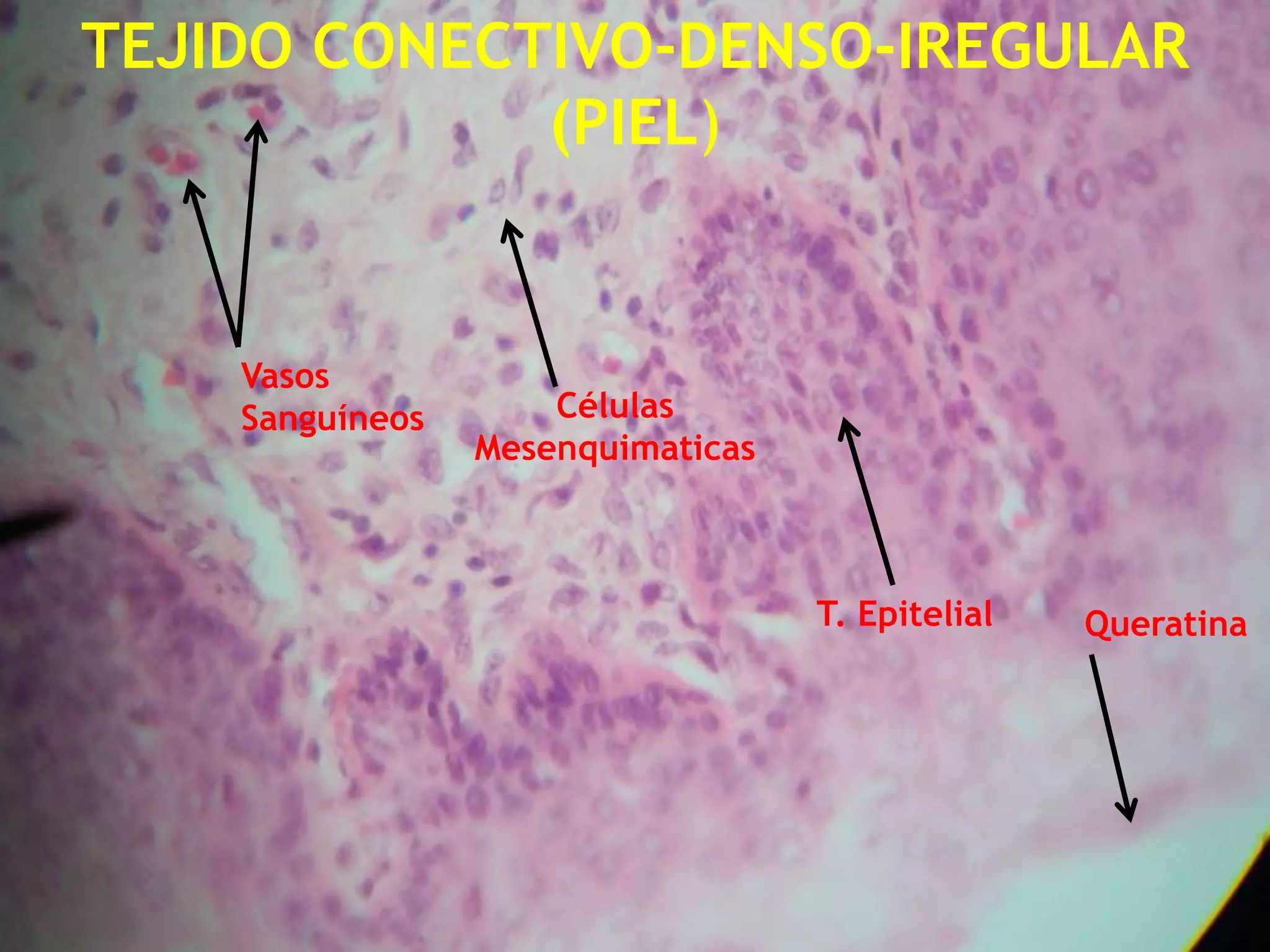 TEJIDO CONECTIVO-DENSO-IREGULAR (PIEL)Vasos SanguíneosCélulas  MesenquimaticasT. EpitelialQueratina