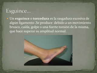  Un esguince o torcedura es la rasgadura excesiva de 
algún ligamento .Se produce debido a un movimiento 
brusco, caída, golpe o una fuerte torsión de la misma, 
que hace superar su amplitud normal. 
 