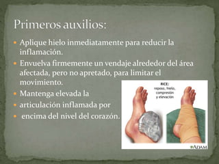  Aplique hielo inmediatamente para reducir la 
inflamación. 
 Envuelva firmemente un vendaje alrededor del área 
afectada, pero no apretado, para limitar el 
movimiento. 
 Mantenga elevada la 
 articulación inflamada por 
 encima del nivel del corazón. 
 