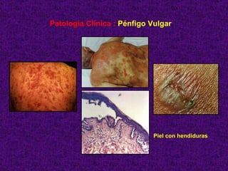 Patología Clínica :  Pénfigo Vulgar Piel con hendiduras 