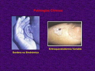 Patologías Clínicas  Sordera no Sindrómica   Eritroqueratodermia Variable 