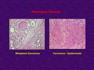 Patologías Clínicas Metaplasia Escamosa   Carcinoma : Epidermoide 