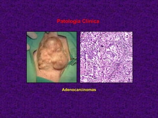 Patología Clínica Adenocarcinomas 