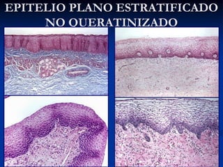 EPITELIO PLANO ESTRATIFICADO
NO QUERATINIZADO

 