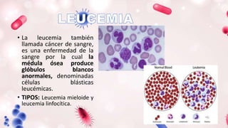 • La leucemia también
llamada cáncer de sangre,
es una enfermedad de la
sangre por la cual la
médula ósea produce
glóbulos blancos
anormales, denominadas
células blásticas
leucémicas.
• TIPOS: Leucemia mieloide y
leucemia linfocítica.
 