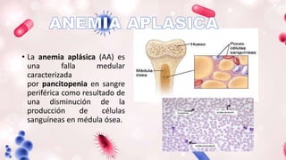 • La anemia aplásica (AA) es
una falla medular
caracterizada
por pancitopenia en sangre
periférica como resultado de
una disminución de la
producción de células
sanguíneas en médula ósea.
 