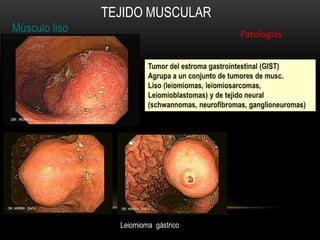 Músculo liso
TEJIDO MUSCULAR
Patologías
Leiomioma gástrico
 