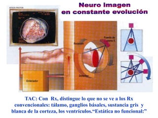 TAC: Con Rx, distingue lo que no se ve a los Rx
 convencionales: tálamo, ganglios básales, sustancia gris y
blanca de la corteza, los ventrículos.“Estática no funcional:”
 