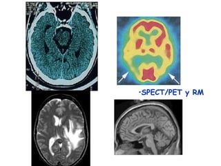•SPECT/PET y RM
 