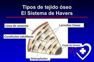 Tipos de tejido óseo
El Sistema de Havers
Canal de Havers
Laminillas Oseas
Osteoplastos
Línea de cemento
Canalículos calcóforos
 