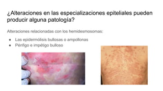 ¿Alteraciones en las especializaciones epiteliales pueden
producir alguna patología?
Alteraciones relacionadas con los hemidesmosomas:
● Las epidermólisis bullosas o ampollonas
● Pénfigo e impétigo bulloso
 