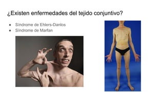 ¿Existen enfermedades del tejido conjuntivo?
● Síndrome de Ehlers-Danlos
● Síndrome de Marfan
 