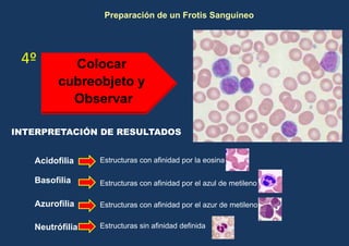 Preparación de un Frotis Sanguíneo




 4º        Colocar
         cubreobjeto y
           Observar

INTERPRETACIÓN DE RESULTADOS


   Acidofilia    Estructuras con afinidad por la eosina

   Basofilia     Estructuras con afinidad por el azul de metileno

   Azurofilia    Estructuras con afinidad por el azur de metileno


   Neutrófilia   Estructuras sin afinidad definida
 