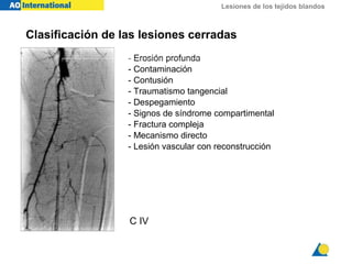 Lesiones de los tejidos blandos
- Erosión profunda
- Contaminación
- Contusión
- Traumatismo tangencial
- Despegamiento
- Signos de síndrome compartimental
- Fractura compleja
- Mecanismo directo
- Lesión vascular con reconstrucción
C IV
Clasificación de las lesiones cerradas
 