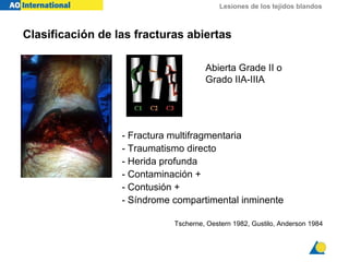 Lesiones de los tejidos blandos
Tscherne, Oestern 1982, Gustilo, Anderson 1984
Abierta Grade II o
Grado IIA-IIIA
Clasificación de las fracturas abiertas
- Fractura multifragmentaria
- Traumatismo directo
- Herida profunda
- Contaminación +
- Contusión +
- Síndrome compartimental inminente
 