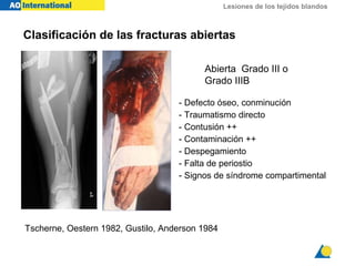 Lesiones de los tejidos blandos
- Defecto óseo, conminución
- Traumatismo directo
- Contusión ++
- Contaminación ++
- Despegamiento
- Falta de periostio
- Signos de síndrome compartimental
Tscherne, Oestern 1982, Gustilo, Anderson 1984
Abierta Grado III o
Grado IIIB
Clasificación de las fracturas abiertas
 