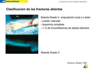Lesiones de los tejidos blandos
Tscherne, Oestern 1982
Abierta Grado V
Abierta Grado V amputación (sub-) o total:
- Lesión vascular
- Isquemia completa
- < ¼ de circunferencia de tejidos blandos
Clasificación de las fracturas abiertas
 