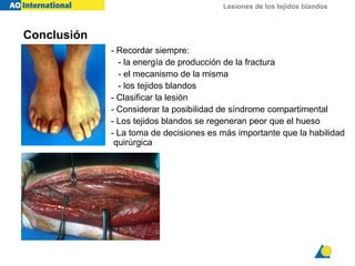 Lesiones de los tejidos blandos
Conclusión
- Recordar siempre:
- la energía de producción de la fractura
- el mecanismo de la misma
- los tejidos blandos
- Clasificar la lesión
- Considerar la posibilidad de síndrome compartimental
- Los tejidos blandos se regeneran peor que el hueso
- La toma de decisiones es más importante que la habilidad
quirúrgica
 