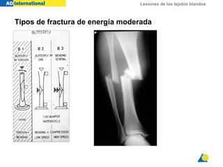 Lesiones de los tejidos blandos
Tipos de fractura de energía moderada
 