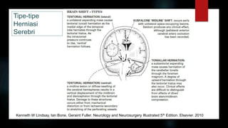 Tipe-tipe
Herniasi
Serebri
Kenneth W Lindsay, Ian Bone, Geraint Fuller. Neurology and Neurosurgery Illustrated 5th Edition. Elsevier. 2010
 