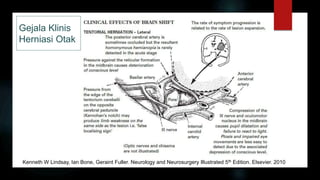 Gejala Klinis
Herniasi Otak
Kenneth W Lindsay, Ian Bone, Geraint Fuller. Neurology and Neurosurgery Illustrated 5th Edition. Elsevier. 2010
 