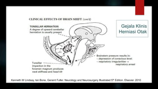 Gejala Klinis
Herniasi Otak
Kenneth W Lindsay, Ian Bone, Geraint Fuller. Neurology and Neurosurgery Illustrated 5th Edition. Elsevier. 2010
 