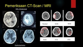 Pemeriksaan CT-Scan / MRI
SOL Intrakranial
Hydrocephalus
 