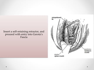Insert a self-retaining retractor, and
proceed with entry into Gerota’s
Fascia
 