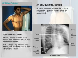 Teknik radiografi (chest xray) | PPTX