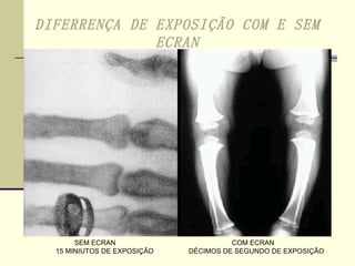 DIFERRENÇA DE EXPOSIÇÃO COM E SEM ECRAN 15 MINIUTOS DE EXPOSIÇÃO DÉCIMOS DE SEGUNDO DE EXPOSIÇÃO SEM ECRAN COM ECRAN 