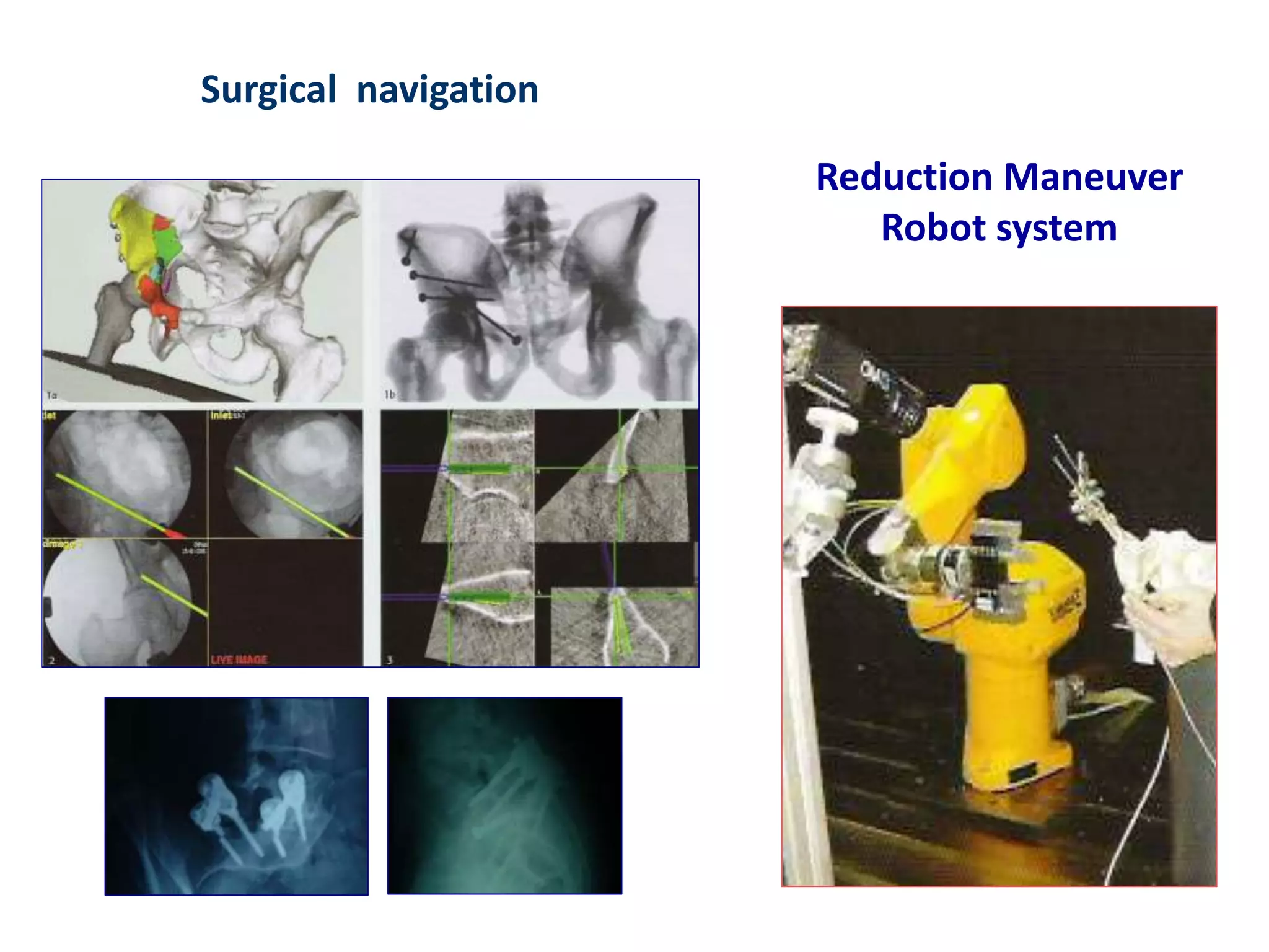 Tele and robotic surgery | PPTX