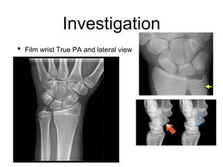 Investigation
• Film wrist True PA and lateral view
 