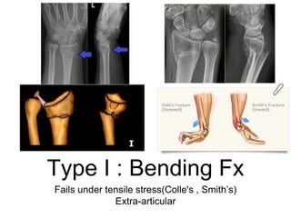 Type I : Bending Fx
Fails under tensile stress(Colle's , Smith’s)
Extra-articular
 
